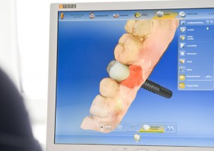 Braunschweiger Zahnarzt - Sirona Implantate